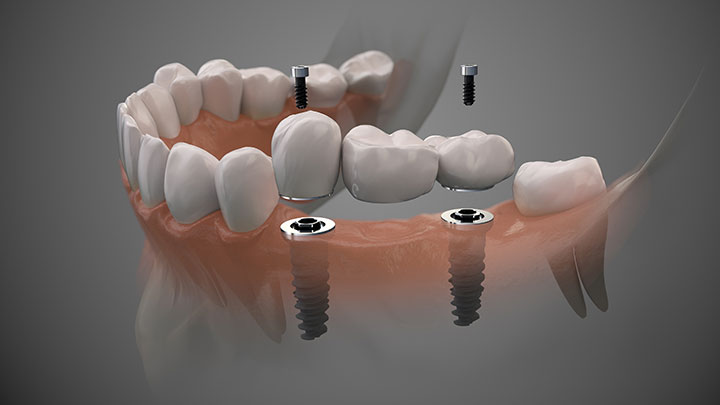 A 3-Diemnsional diagram showing an implant system to hold a 3-unit fixed denture