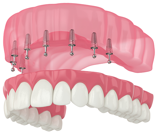 A 3-dimensional diagram illustrating a removable full upper denture over implants in th eupper jaw